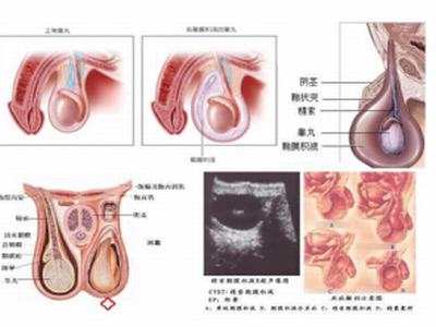 儿童睾丸鞘膜积液护理措施有哪些
